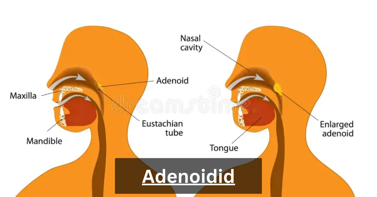 Adenoidid